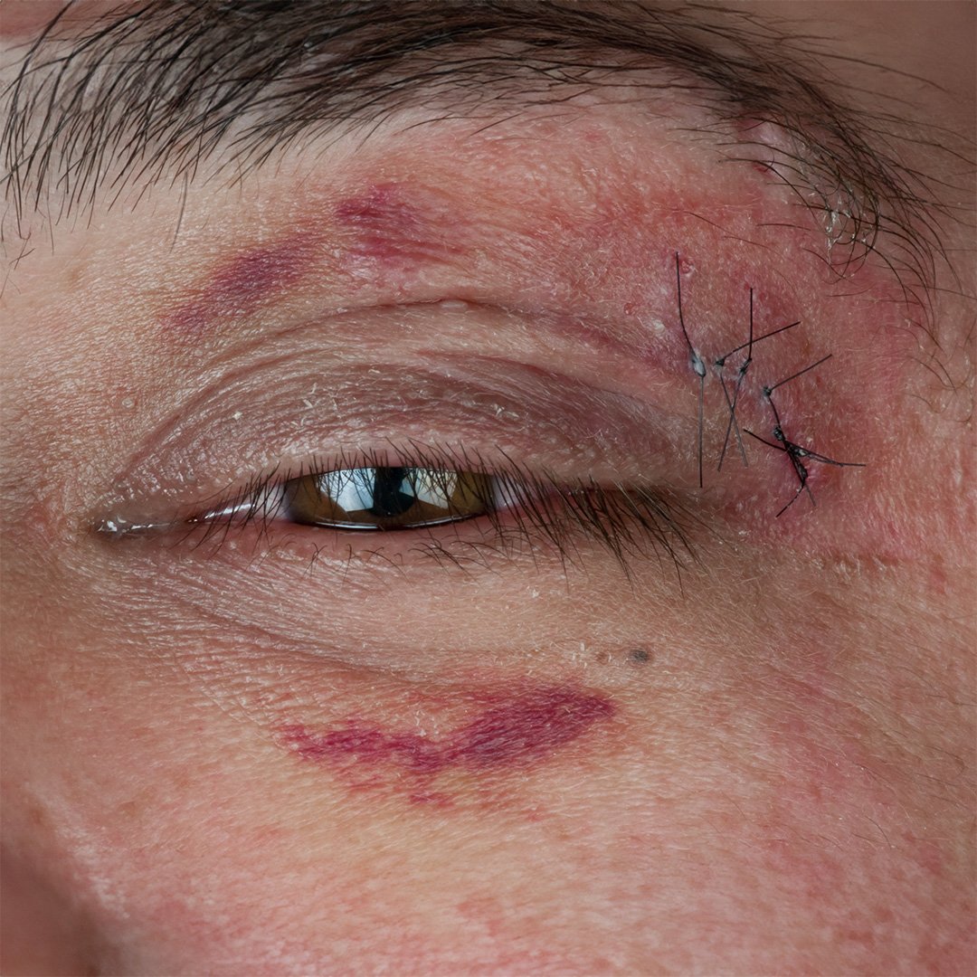 Ojo con heridas palpebrales por trauma – accidentes